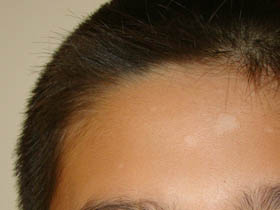 头部患上白斑治疗容易、白癜风治疗